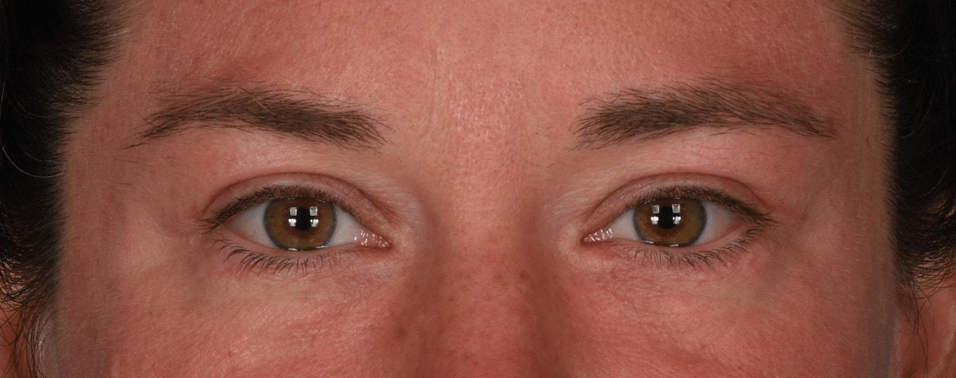 Tara Chadab, MD eyelid lift after — New York, NY