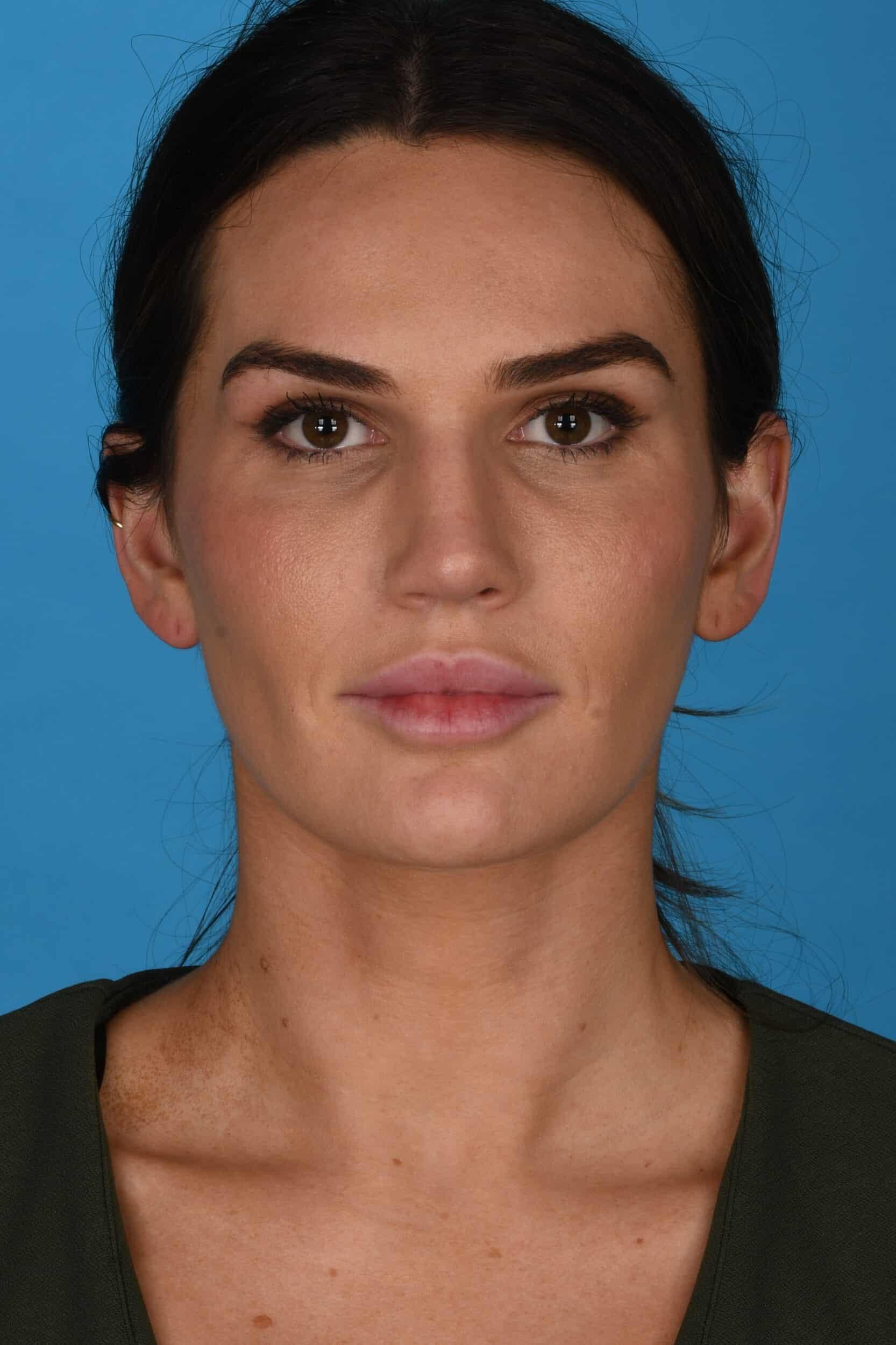 Tara Chadab, MD rhinoplasty after — New York, NY