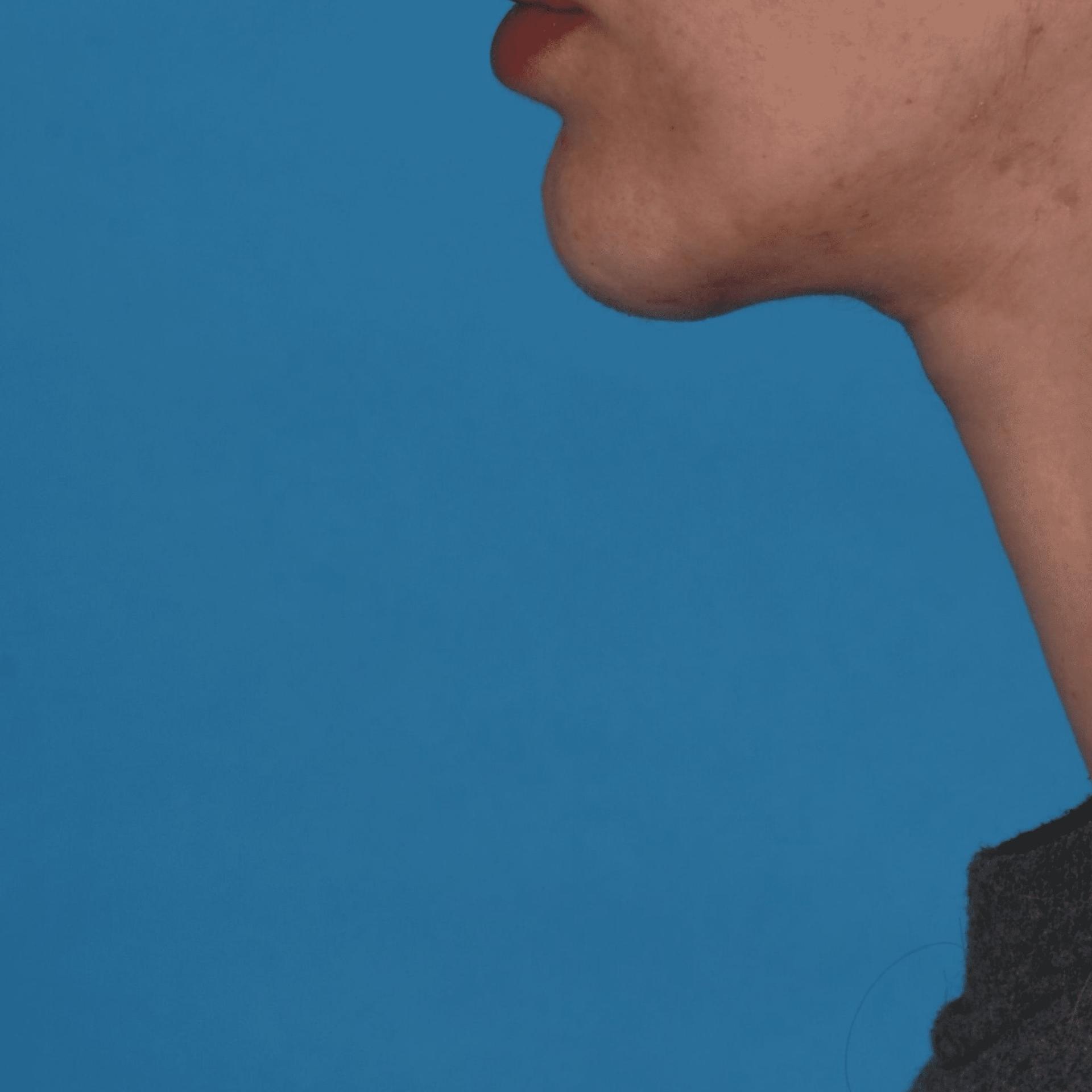 Tara Chadab, MD facelift after — New York, NY