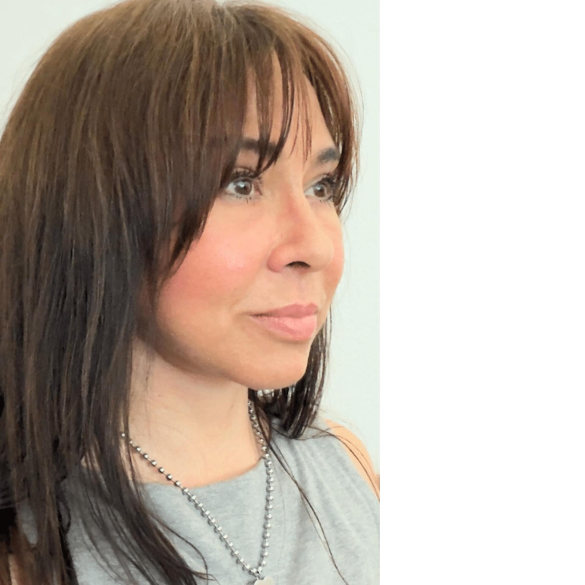 Tara Chadab, MD facelift after — New York, NY