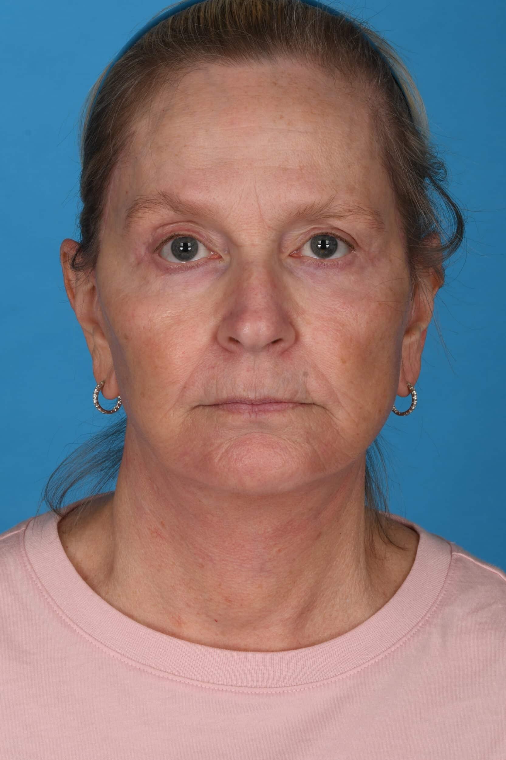 Tara Chadab, MD facelift after — New York, NY