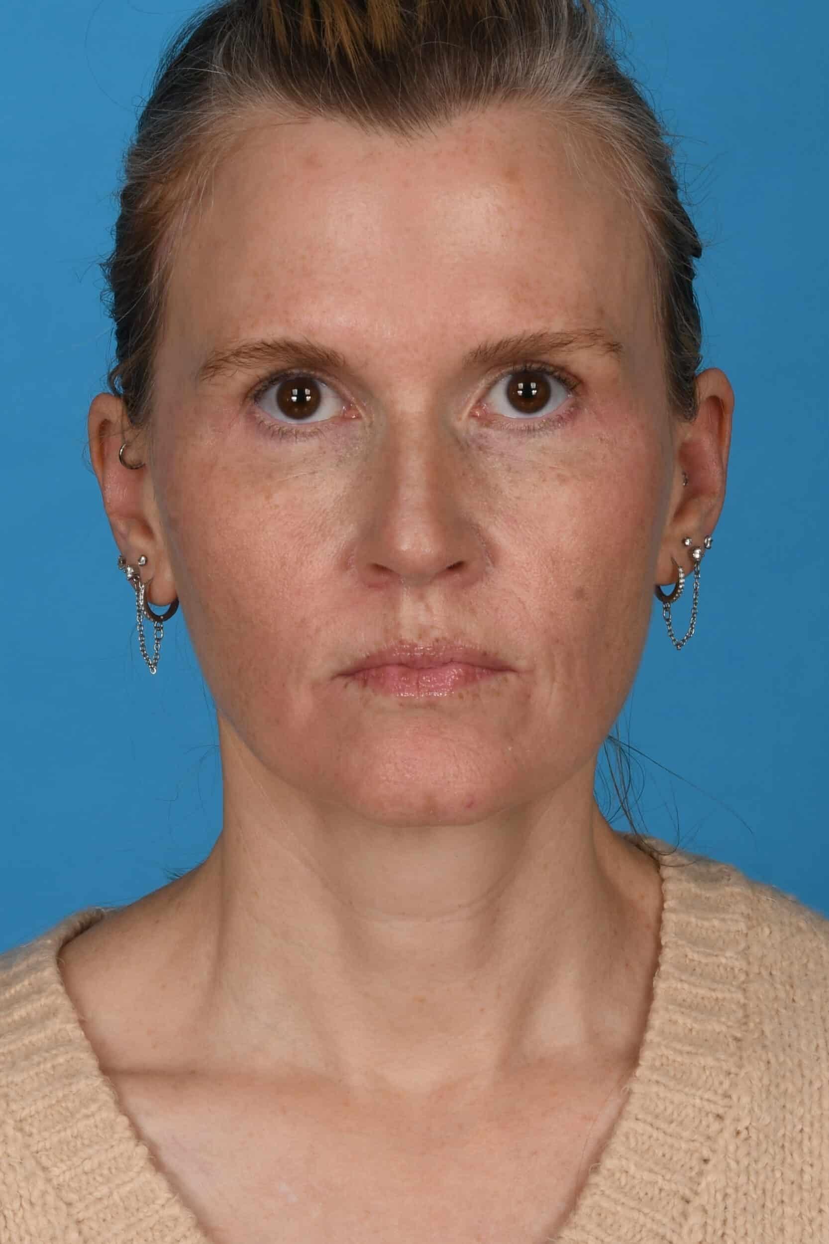 Tara Chadab, MD eyelid lift after — New York, NY