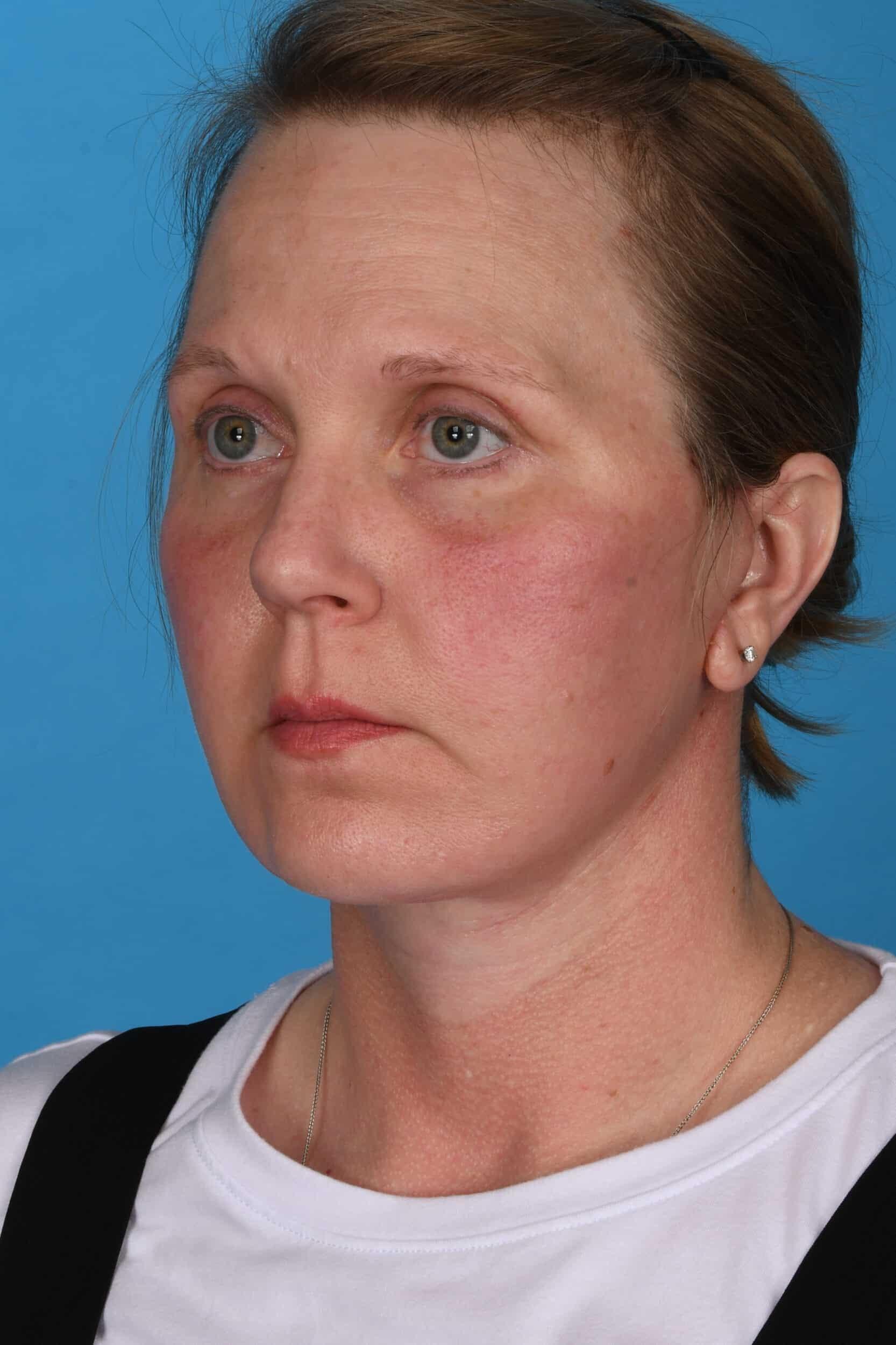 Tara Chadab, MD facelift after — New York, NY