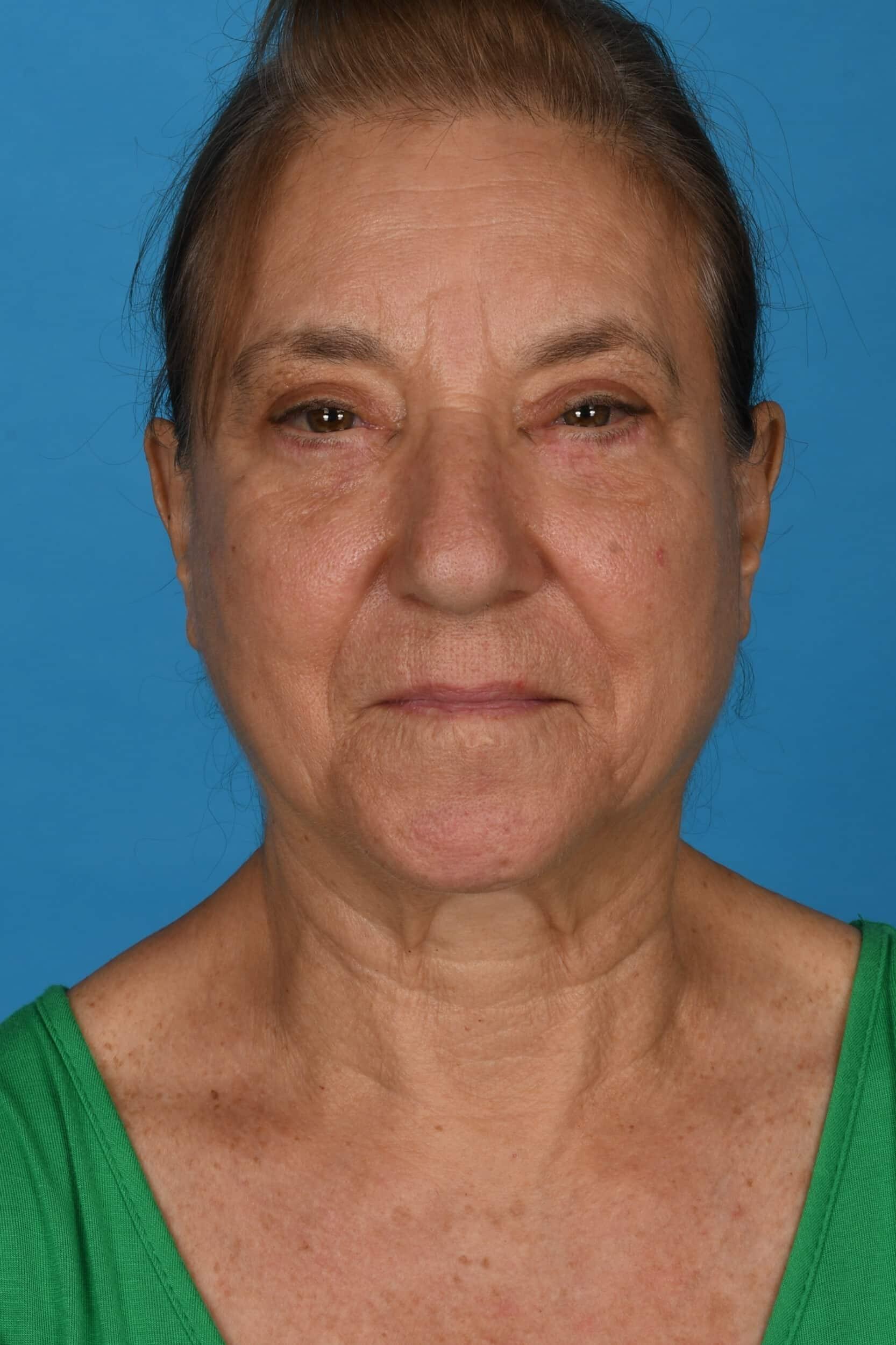 Tara Chadab, MD eyelid lift after — New York, NY