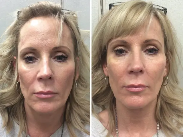 Juvederm result at Modern SLC in Holladay, UT