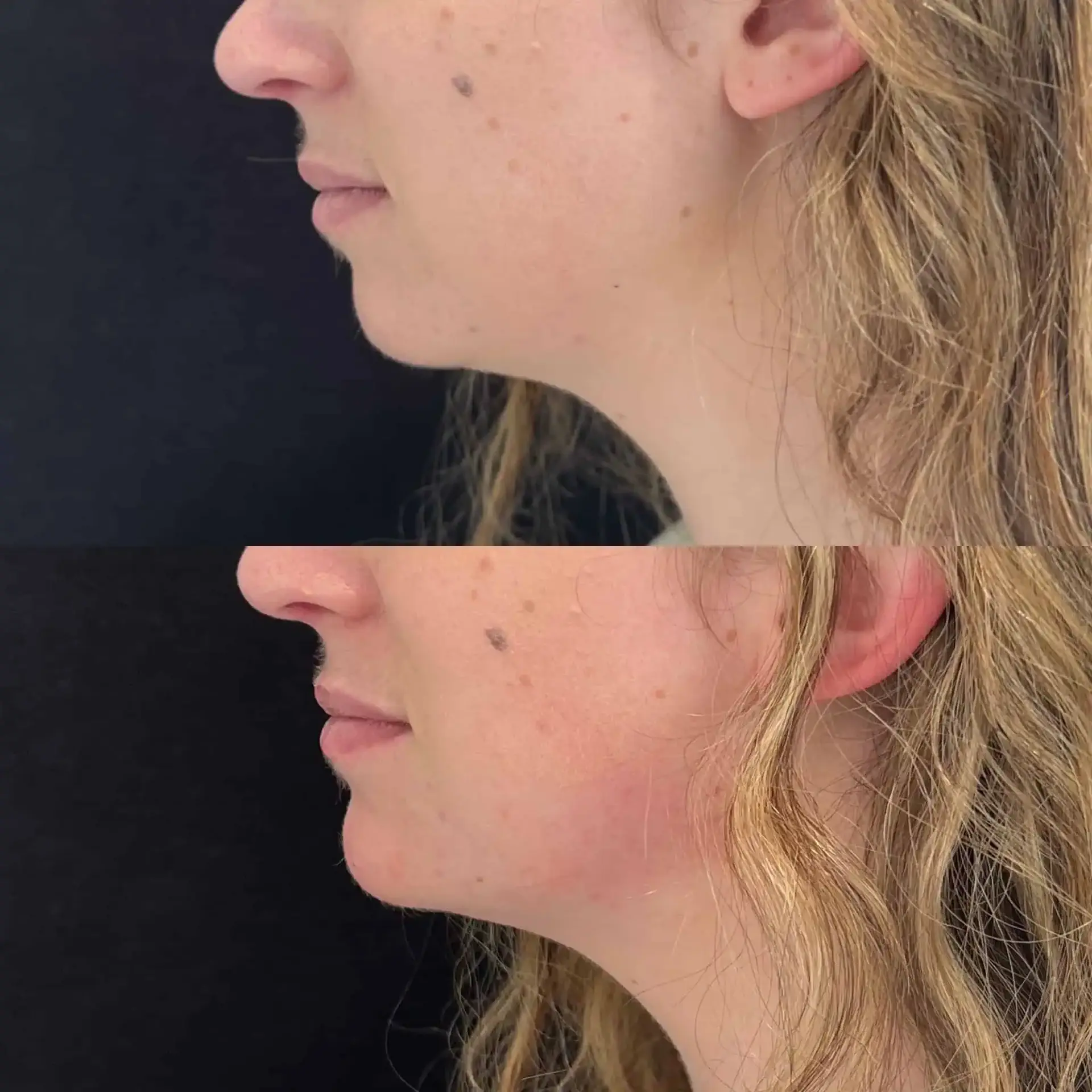 Modern SLC jawline filler result — Holladay, UT