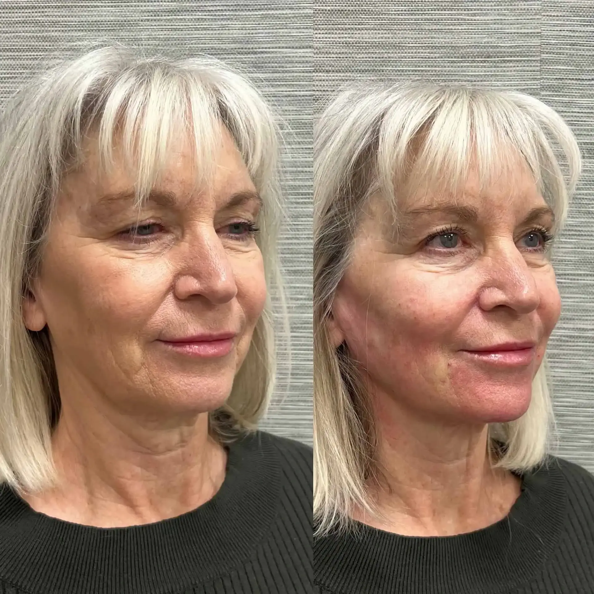 Modern SLC jawline filler result — Holladay, UT