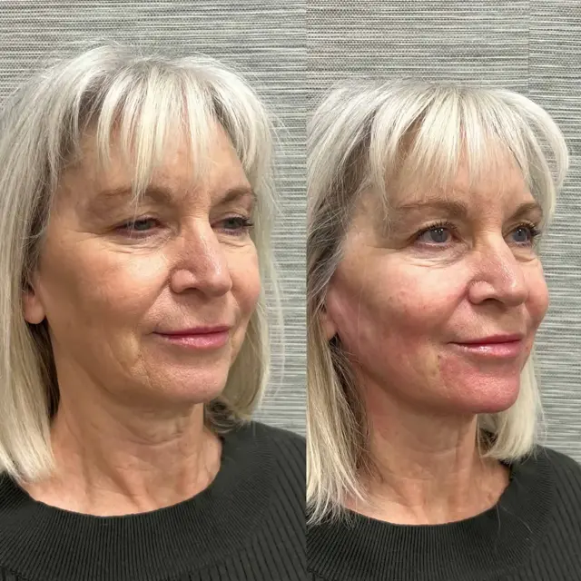 Jawline Filler result at Modern SLC in Holladay, UT