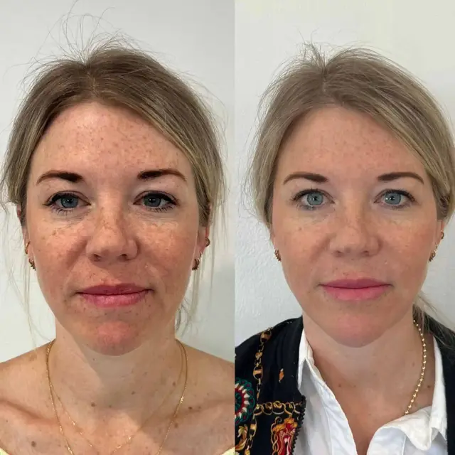 Dermal Fillers result at Modern SLC in Salt Lake City, UT