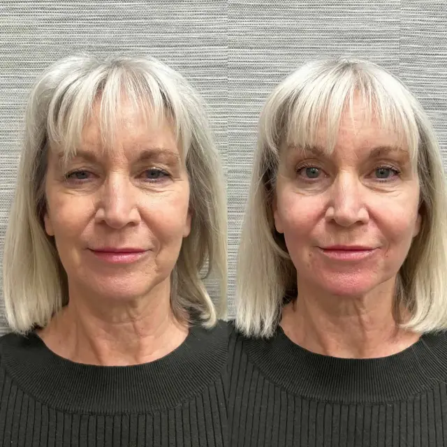 Dermal Fillers result at Modern SLC in Salt Lake City, UT