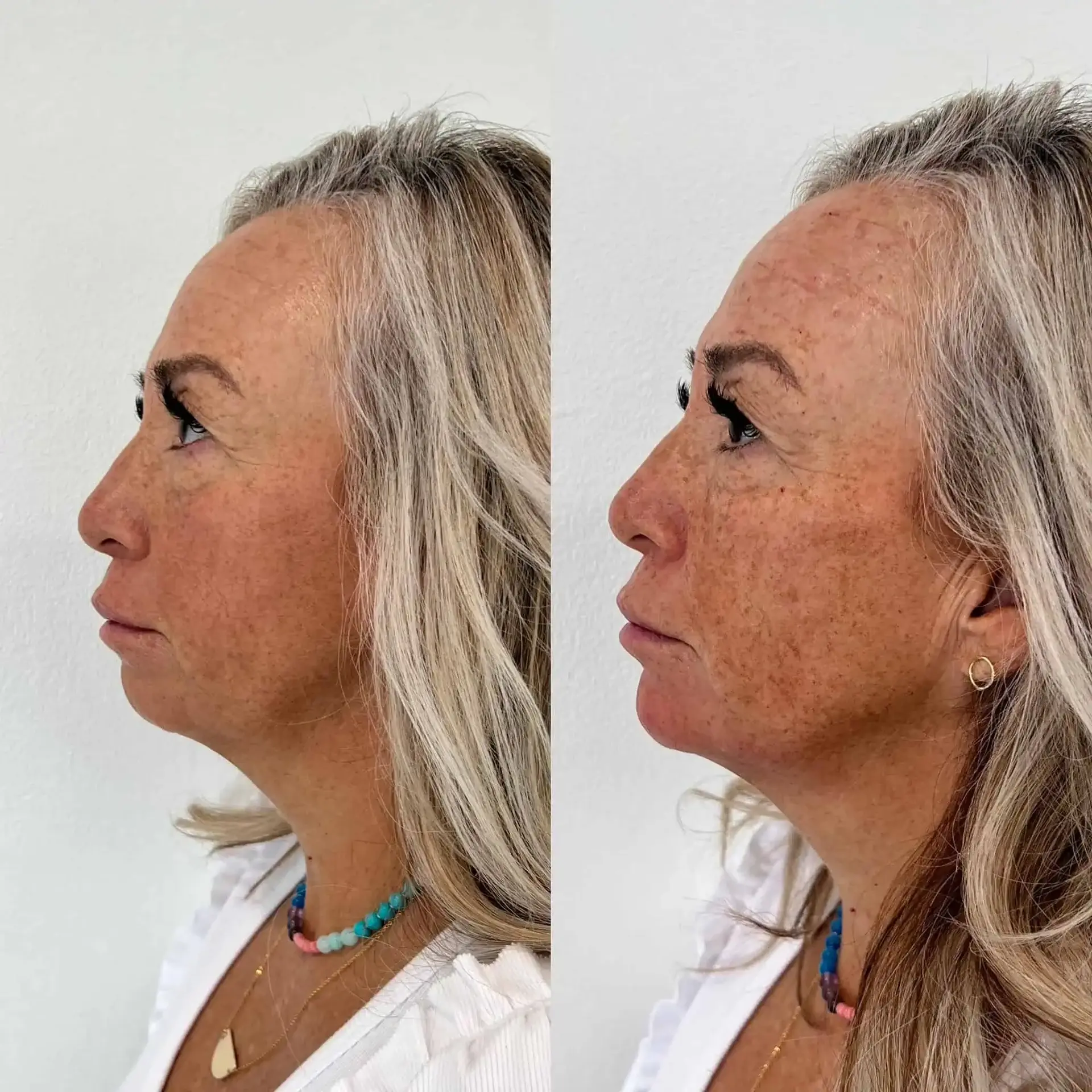 Modern SLC jawline filler result — Holladay, UT