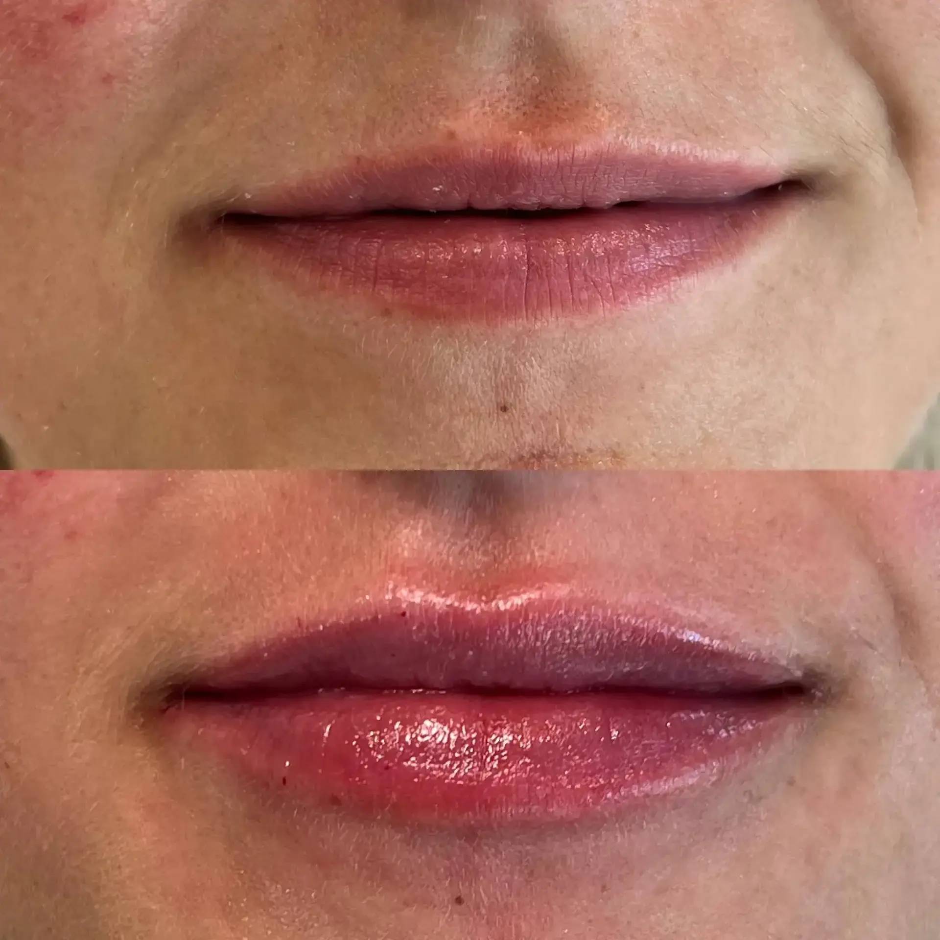 Modern SLC lip filler result — Holladay, UT
