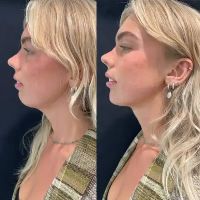 Jawline Filler result at Modern SLC in Holladay, UT