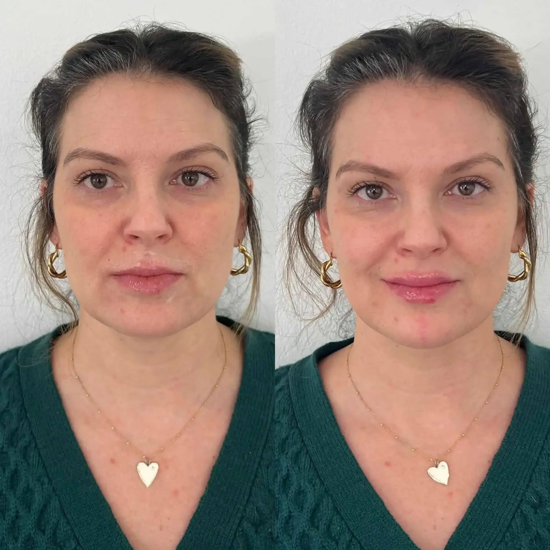 Modern SLC lip filler result — Holladay, UT