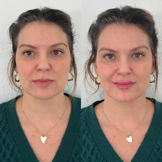 Lip Filler result at Modern SLC in Holladay, UT