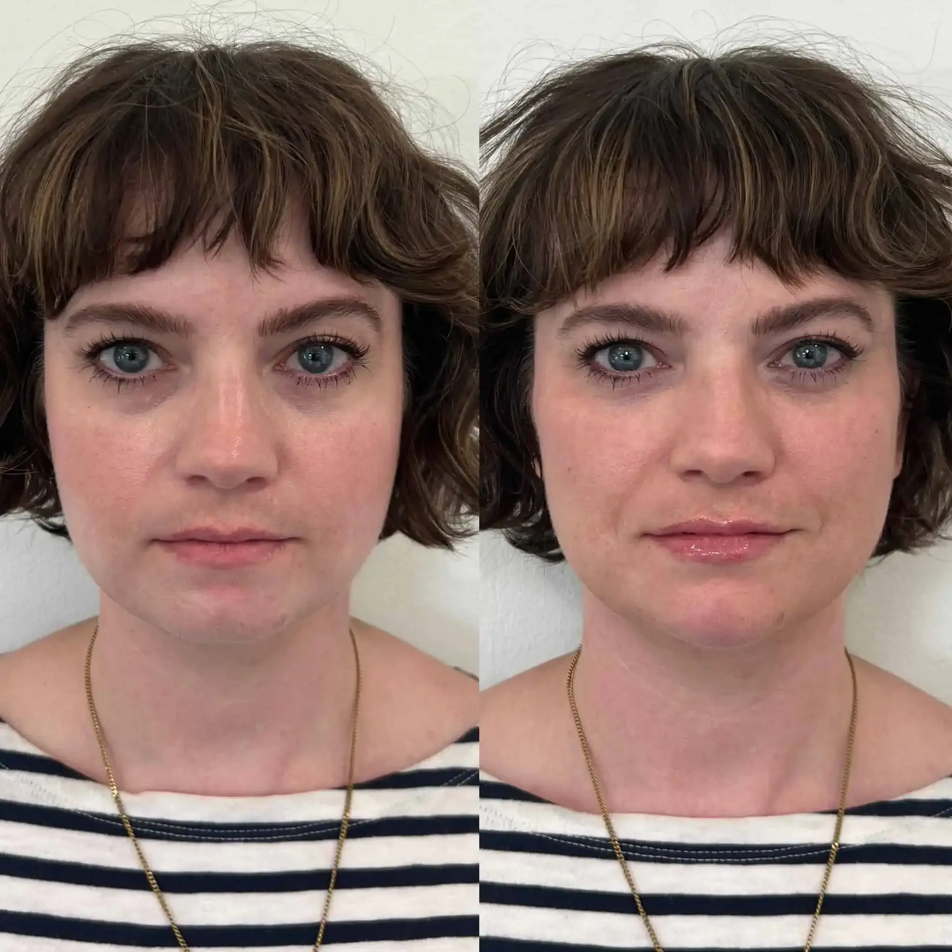Modern SLC lip filler result — Holladay, UT