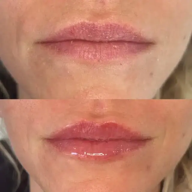 Modern SLC lip filler result — Holladay, UT