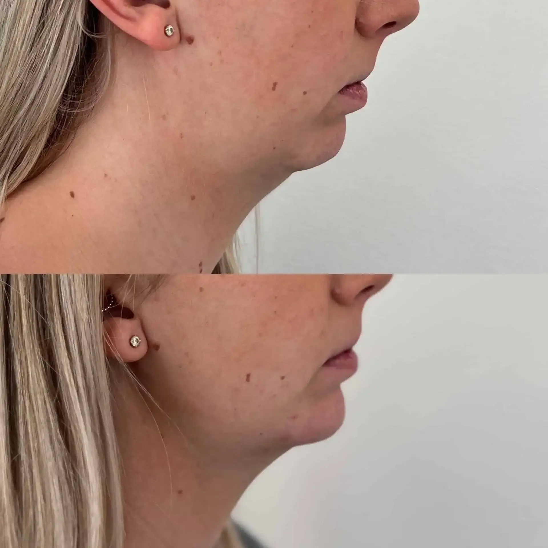 Modern SLC jawline filler result — Holladay, UT
