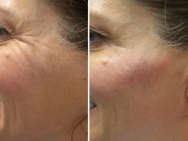Botox result at Modern SLC in Holladay, UT