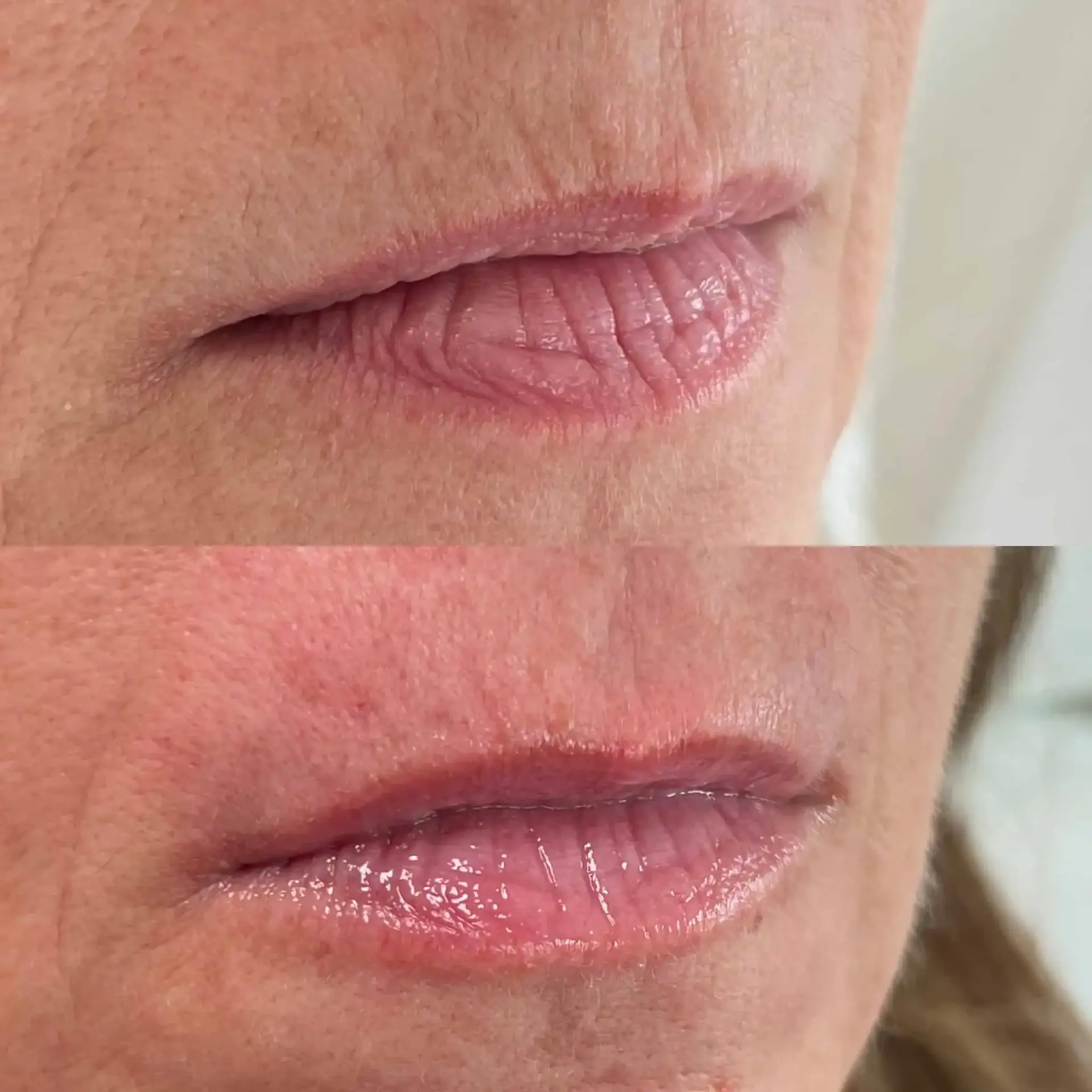 Modern SLC lip filler result — Holladay, UT