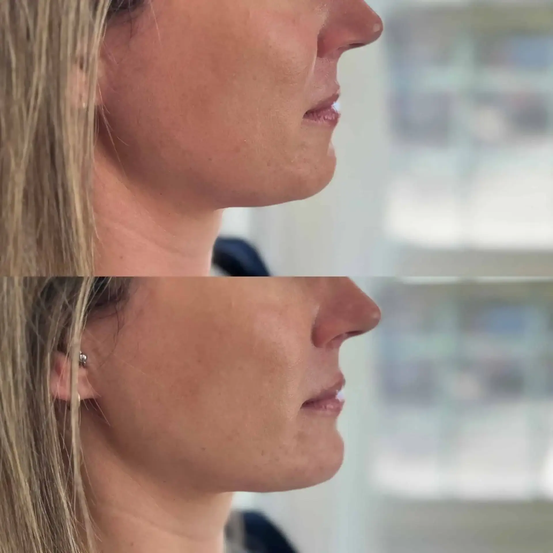Modern SLC jawline filler result — Holladay, UT