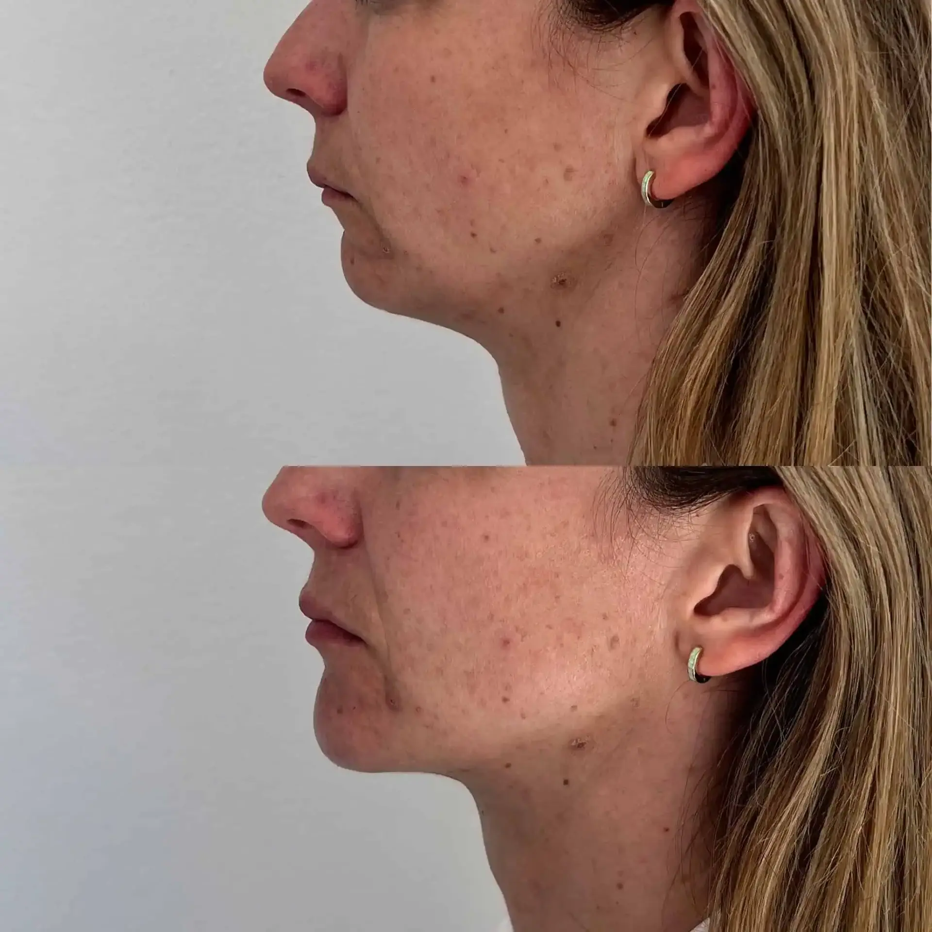 Modern SLC jawline filler result — Holladay, UT