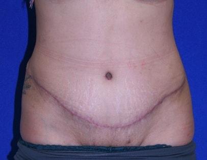 Virginia Center for Plastic Surgery tummy tuck after — Alexandria, VA