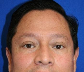 Virginia Center for Plastic Surgery eyelid lift after — Alexandria, VA