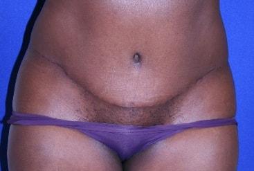 Virginia Center for Plastic Surgery tummy tuck after — Alexandria, VA