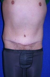 Virginia Center for Plastic Surgery tummy tuck after — Alexandria, VA