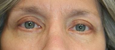 Virginia Center for Plastic Surgery eyelid lift after — Alexandria, VA
