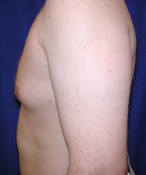 Virginia Center for Plastic Surgery gynecomastia after — Alexandria, VA