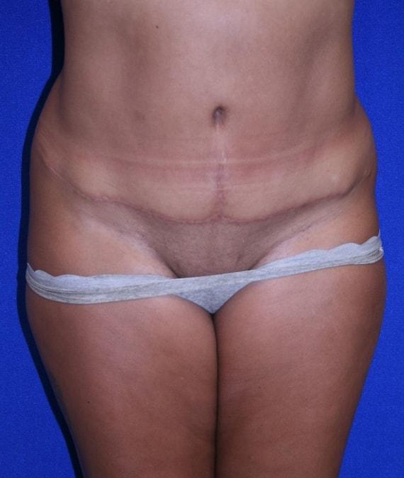Virginia Center for Plastic Surgery tummy tuck after — Alexandria, VA