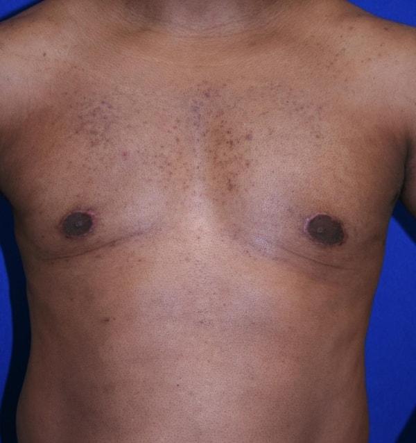 Virginia Center for Plastic Surgery gynecomastia after — Alexandria, VA