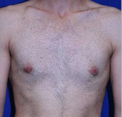 Virginia Center for Plastic Surgery gynecomastia after — Alexandria, VA