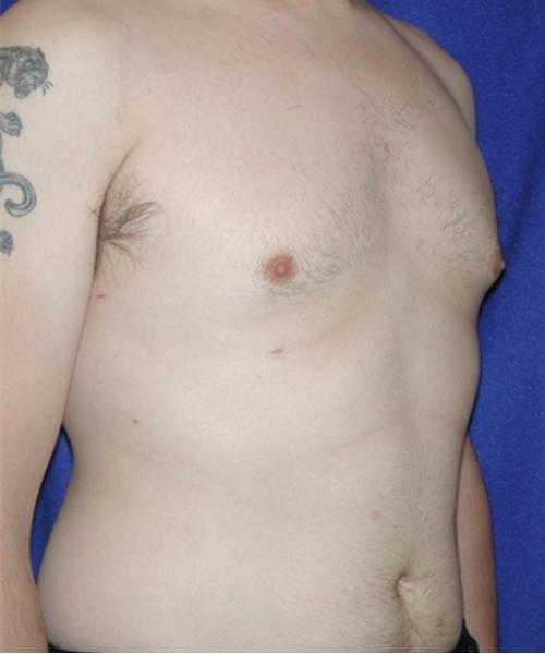 Virginia Center for Plastic Surgery gynecomastia after — Alexandria, VA