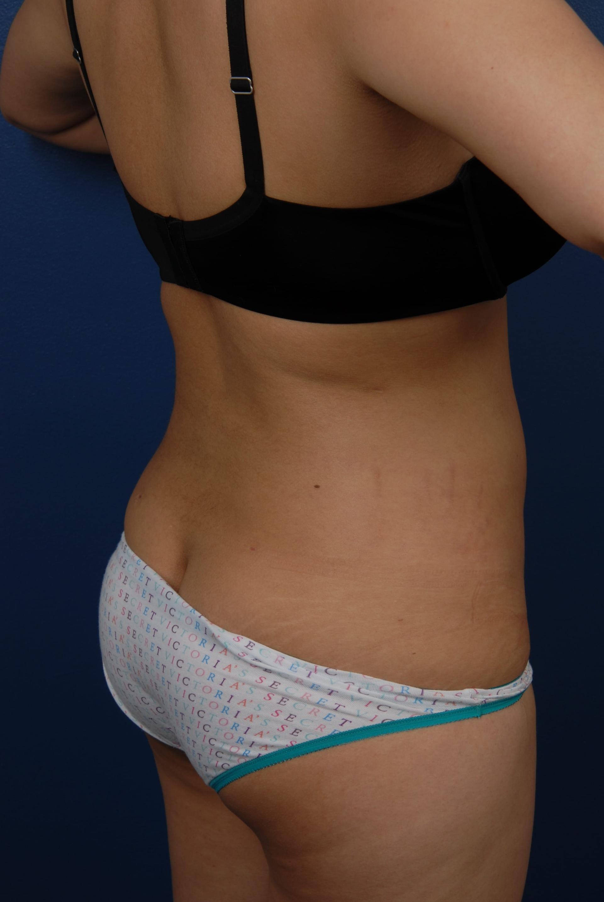 Bass Plastic Surgery liposuction after — New York, NY