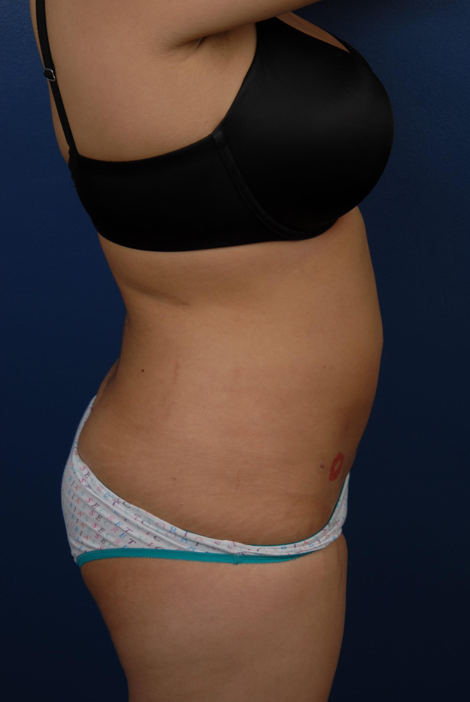 Bass Plastic Surgery liposuction after — New York, NY