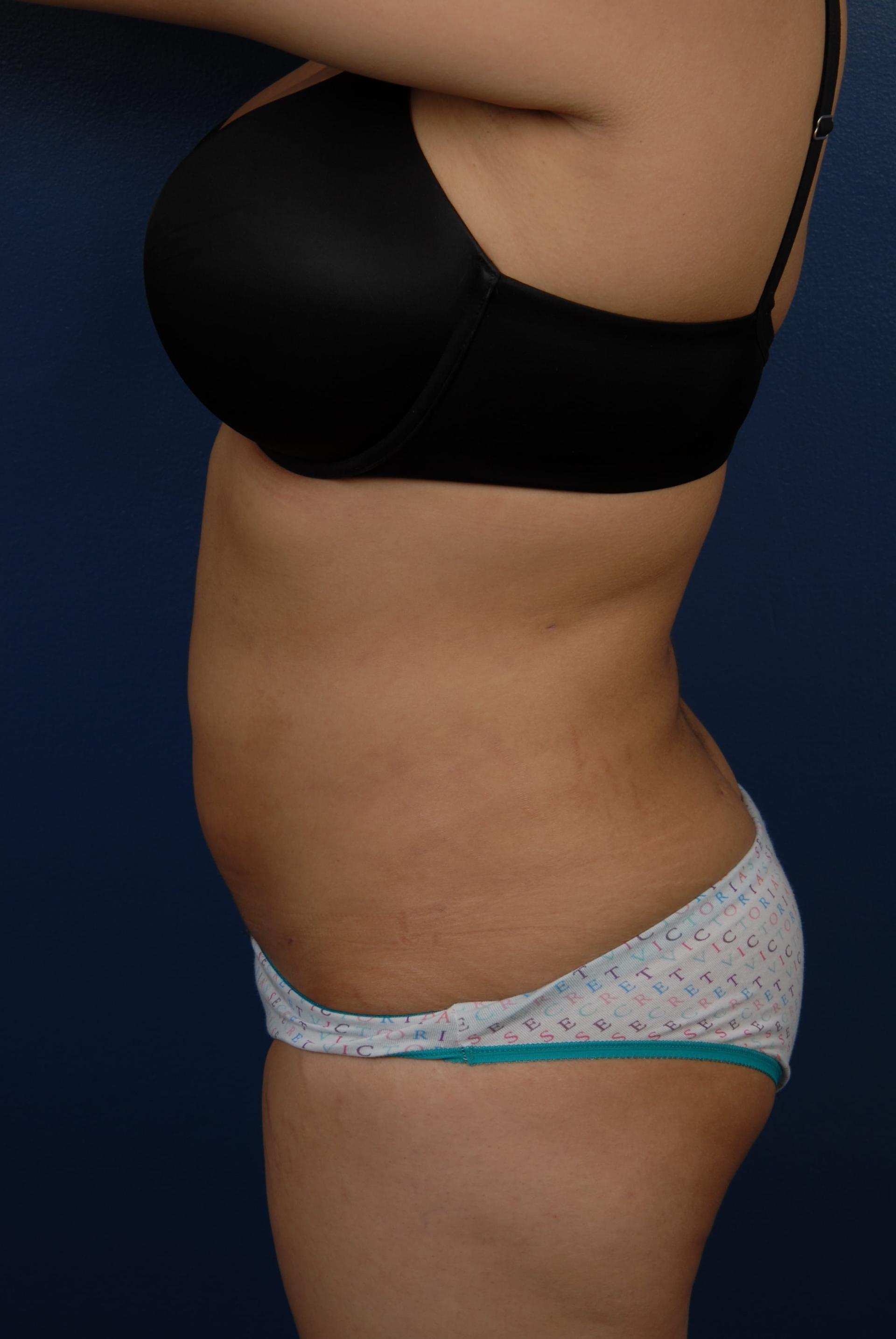 Bass Plastic Surgery liposuction after — New York, NY