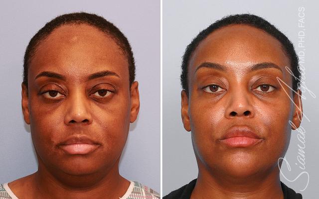 Brow Lift result at The Aesthetic Centers in Newport Beach, CA