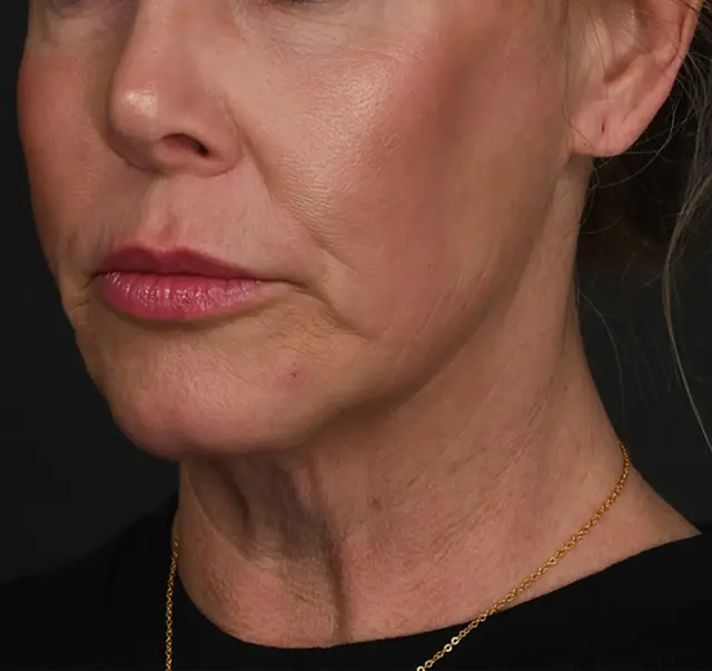 Neck Lift before at Meade Aesthetic Surgery in Dallas, TX