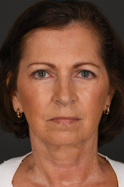 Meade Aesthetic Surgery after — Dallas, TX
