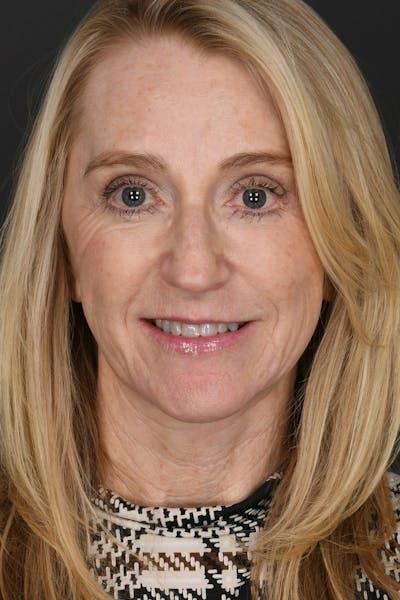 Meade Aesthetic Surgery after — Dallas, TX