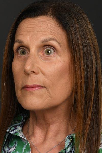 Facelift after at Meade Aesthetic Surgery in Dallas, TX