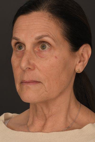 Facelift before at Meade Aesthetic Surgery in Dallas, TX