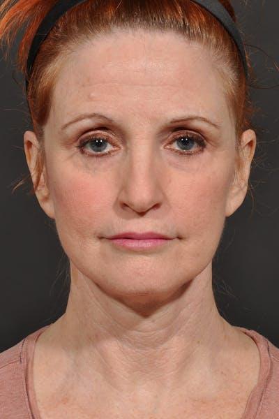 Meade Aesthetic Surgery after — Dallas, TX