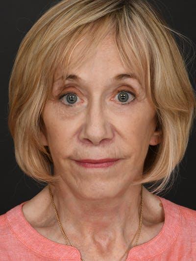 Meade Aesthetic Surgery after — Dallas, TX