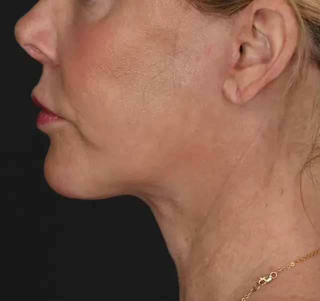 Neck Lift after at Meade Aesthetic Surgery in Dallas, TX
