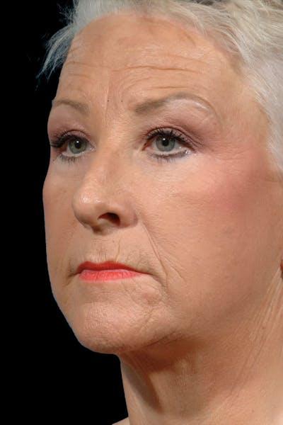 Meade Aesthetic Surgery after — Dallas, TX