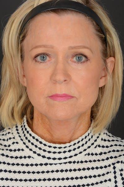 Facelift after at Meade Aesthetic Surgery in Dallas, TX